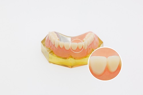 人工歯：歯の部分