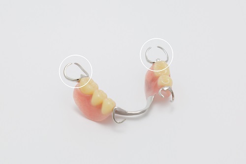 維持装置：義歯を支え固定する金属製の留め具